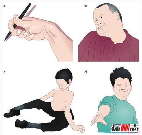 中國世界首例舞蹈豬,亨廷頓氏舞蹈癥是什么??？